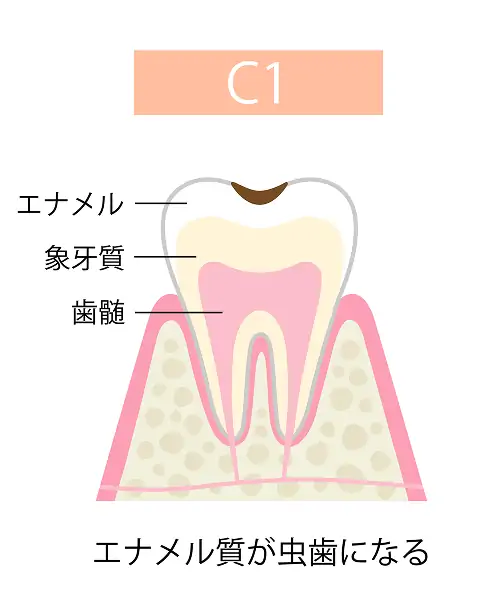 エナメル質が虫歯になる