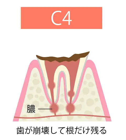 歯が崩壊して根だけ残る